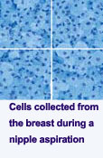 Cells collected from the breast during a nipple aspiration